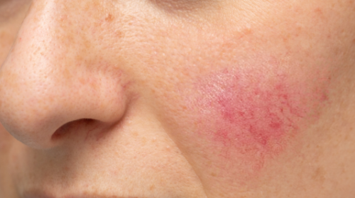 rosacea and redness young woman croped